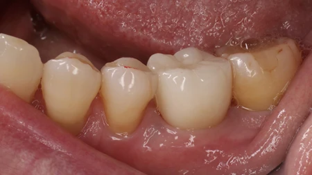 奥歯の症例 抜歯と同時にインプラント埋入 治療後