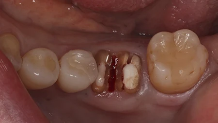 奥歯の症例 抜歯と同時にインプラント埋入 治療前