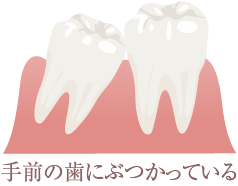 手前の歯にぶつかっている