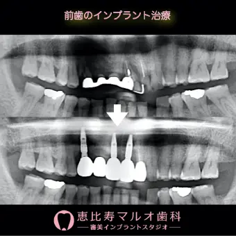 前歯のインプラント治療 術前と術後のレントゲン写真