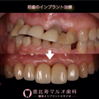 前歯のインプラント治療 術前と術後の写真