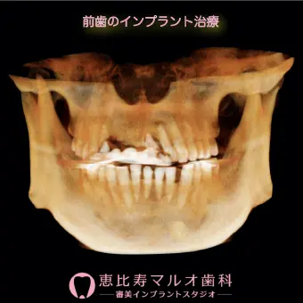 前歯のインプラント治療 術前の状態を最先端のCTで撮影