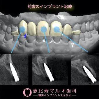 前歯のインプラント治療 インプラントの治療計画と実際の埋入後のCT