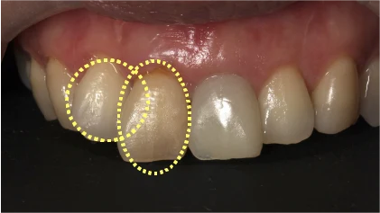 前歯のインプラント治療の症例1 治療前
