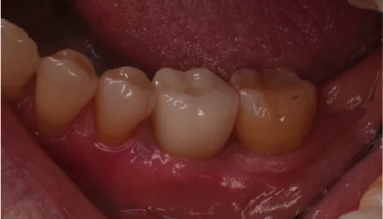 奥歯のインプラント治療の症例1 治療後