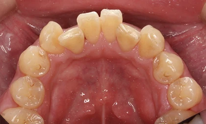 恵比寿マルオ歯科のホワイトニングの症例1 治療後
