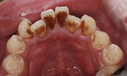 恵比寿マルオ歯科のホワイトニングの症例1 治療前