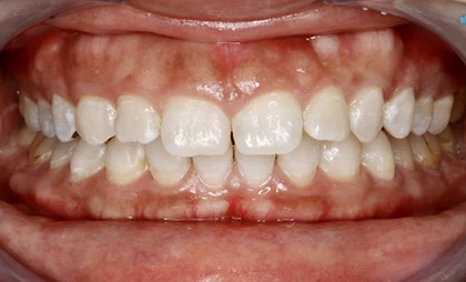 恵比寿マルオ歯科のホワイトニングの症例2 治療後