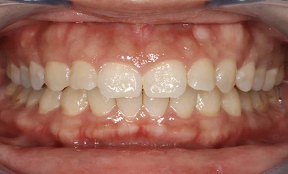 恵比寿マルオ歯科のホワイトニングの症例2 治療前