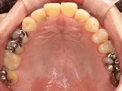 恵比寿マルオ歯科のホワイトニングの症例3 治療後