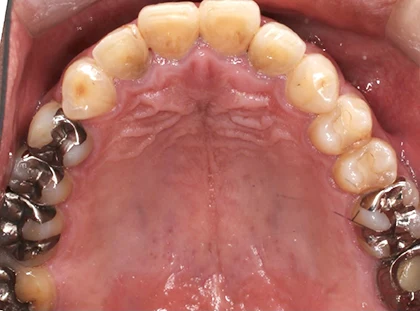 恵比寿マルオ歯科のホワイトニングの症例3 治療前