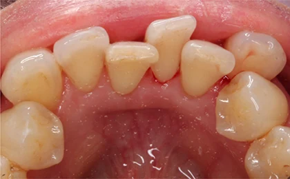 恵比寿マルオ歯科のホワイトニングの症例4 治療後