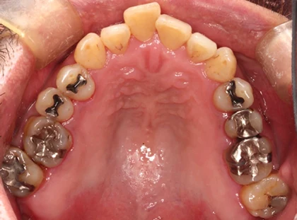 恵比寿マルオ歯科のホワイトニングの症例5 治療後