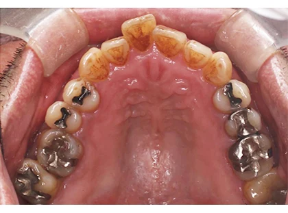 恵比寿マルオ歯科のホワイトニングの症例5 治療前