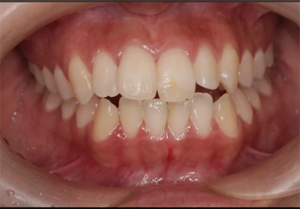 恵比寿マルオ歯科のホワイトニングの症例7 治療前