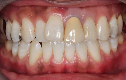 恵比寿マルオ歯科のホワイトニングの症例6 治療後