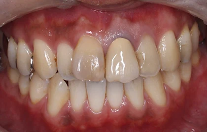 恵比寿マルオ歯科のホワイトニングの症例6 治療前