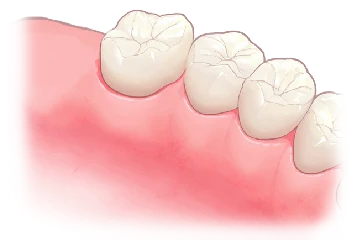 奥歯1本のインプラント治療
