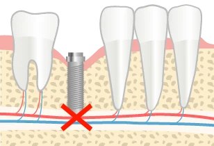 奥歯のインプラント治療のリスク 下顎