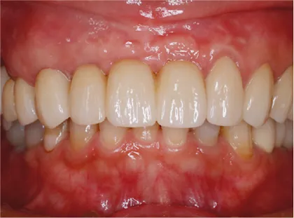 オールオン4症例 上顎部分欠損に対するオールオン6によるインプラント治療 治療後