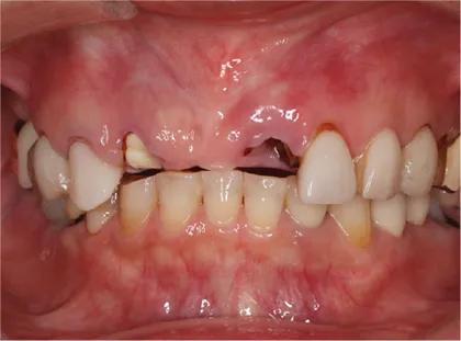 オールオン4症例 上顎部分欠損に対するオールオン6によるインプラント治療 治療前
