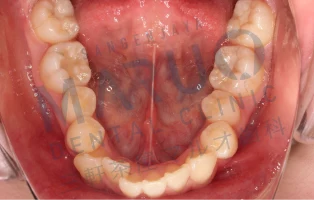 orthodontics_case_03.png