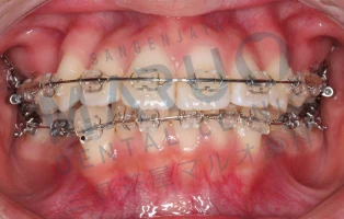 orthodontics_case_05.png