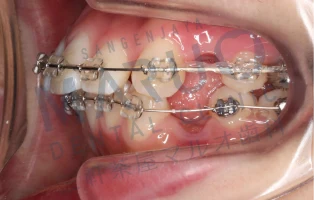 orthodontics_case_08.png