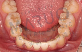 orthodontics_case_11.png