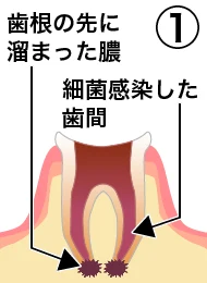 root_canal_flow_1.png