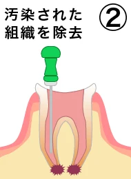 root_canal_flow_2.png