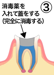 root_canal_flow_3.png