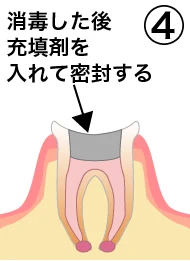 root_canal_flow_4.png