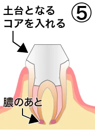 root_canal_flow_5.png