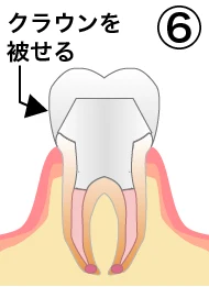 root_canal_flow_6.png