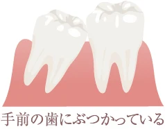 手前の歯にぶつかっている