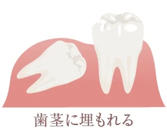 歯茎に埋もれる