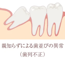 親知らずによる歯並びの異常（歯列不正）