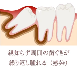 親知らず周囲の歯茎が繰り返し晴れる（感染）