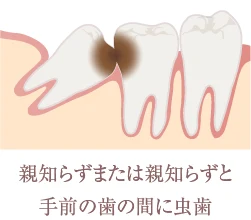 親知らずまたは親知らずと手前の歯の間に虫歯