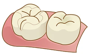 インレー
