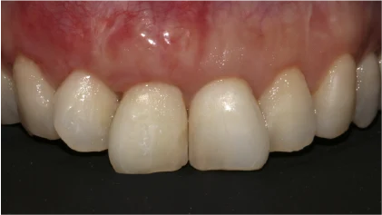 前歯のインプラント治療の症例1 治療後