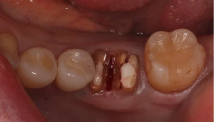 奥歯のインプラント治療の症例1 治療前