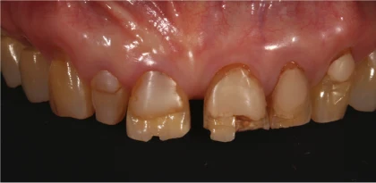 セラミック治療の症例8 治療前