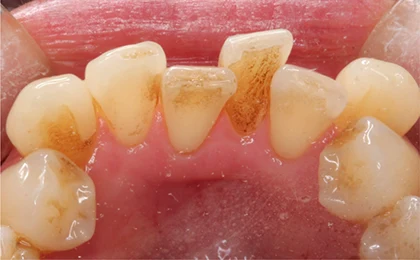 恵比寿マルオ歯科のホワイトニングの症例4 治療前