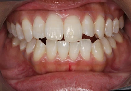 恵比寿マルオ歯科のホワイトニングの症例7 治療後