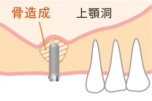 上顎のインプラント治療のリスク