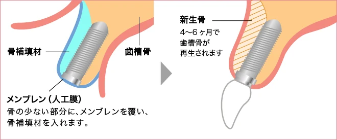 骨が不足してしまっている部分に骨を造成する術式