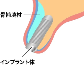 上顎洞底挙上術の術式 同時法