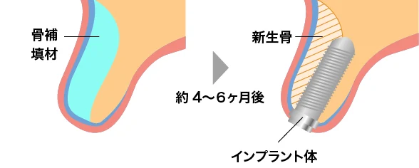 上顎洞底挙上術の術式 段階法